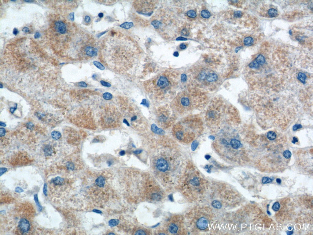 IHC staining of human hepatocirrhosis using 14371-1-AP