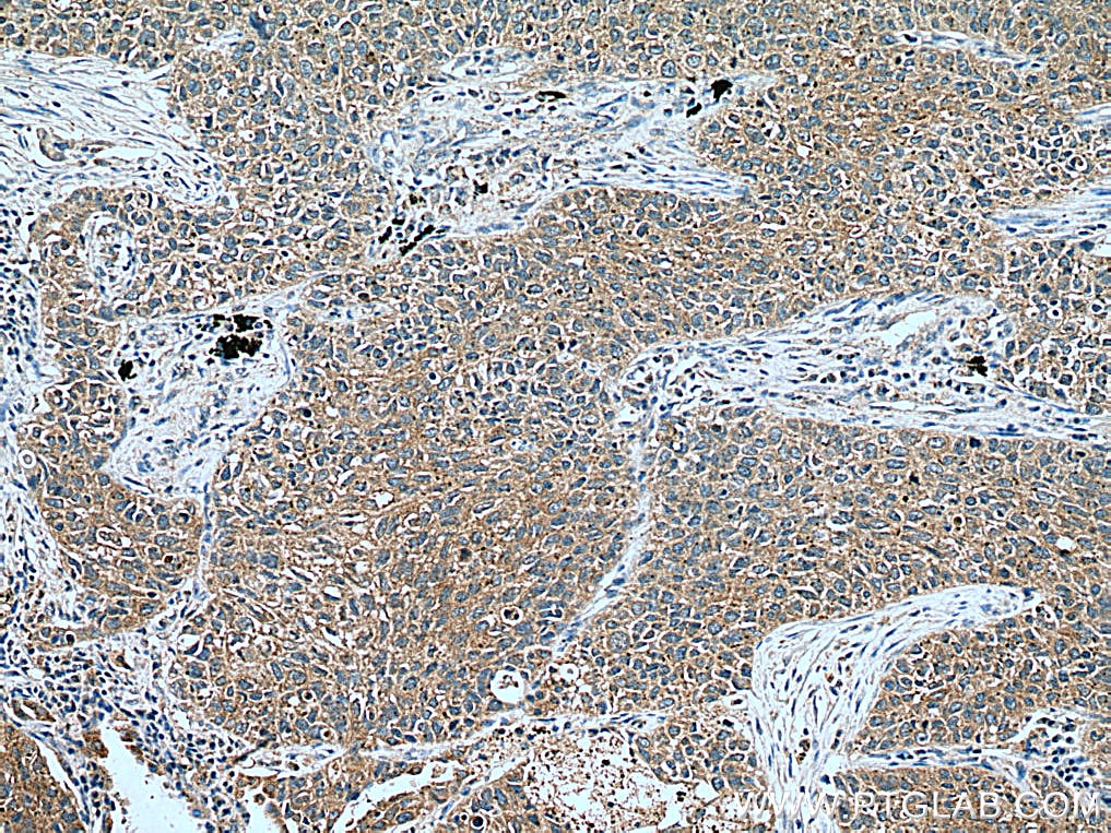 Immunohistochemistry (IHC) staining of human lung cancer tissue using WNT5A/B Polyclonal antibody (55184-1-AP)