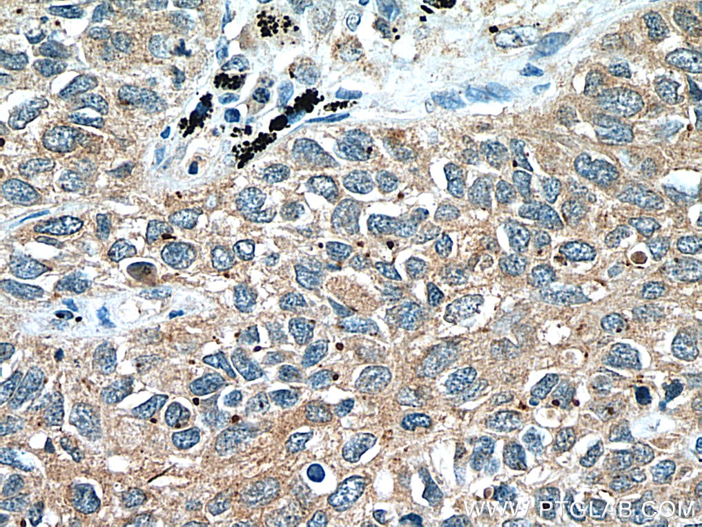 IHC staining of human lung cancer using 55184-1-AP