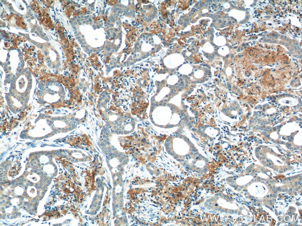 IHC staining of human lung cancer using 55184-1-AP