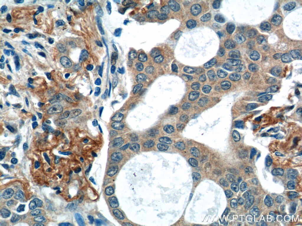 Immunohistochemistry (IHC) staining of human lung cancer tissue using WNT5A/B Polyclonal antibody (55184-1-AP)