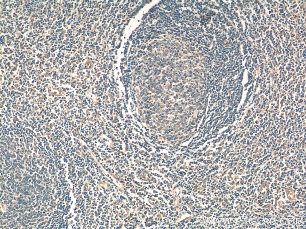 Immunohistochemistry (IHC) staining of human tonsillitis tissue using WNT5A/B Polyclonal antibody (55184-1-AP)