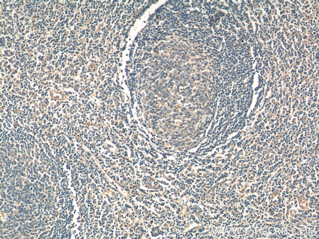 IHC staining of human tonsillitis using 55184-1-AP