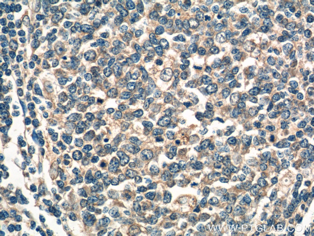 Immunohistochemistry (IHC) staining of human tonsillitis tissue using WNT5A/B Polyclonal antibody (55184-1-AP)