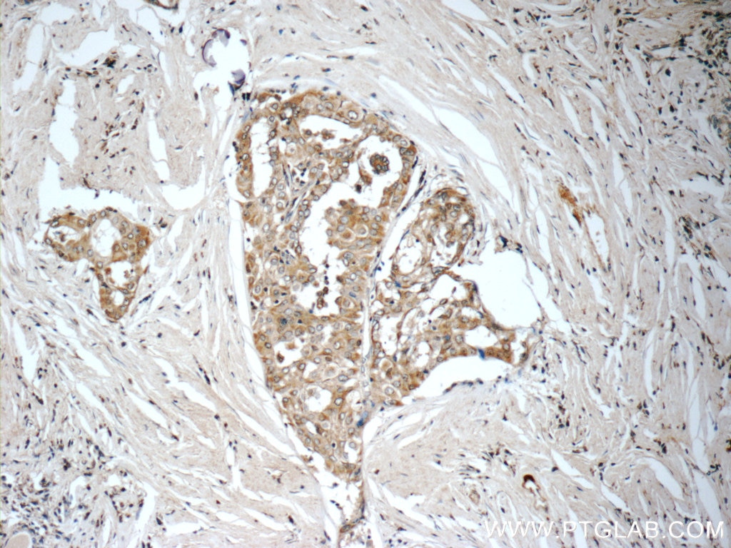 Immunohistochemistry (IHC) staining of human thyroid cancer tissue using WNT5A/B Polyclonal antibody (55184-1-AP)