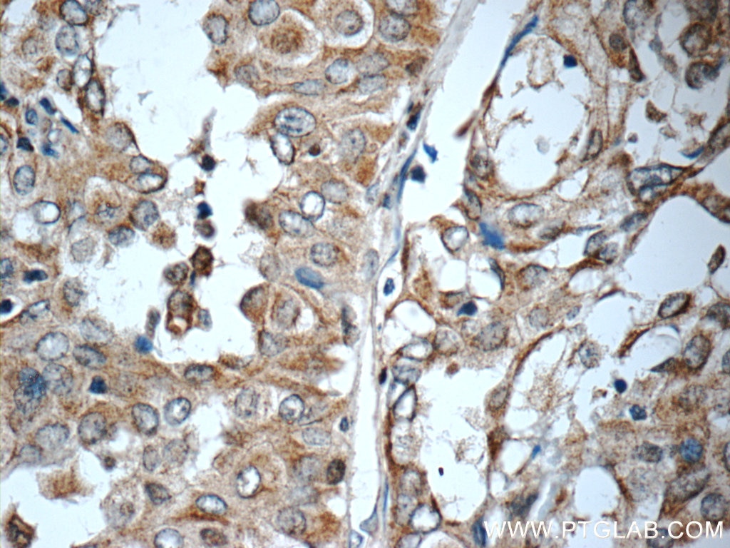 Immunohistochemistry (IHC) staining of human thyroid cancer tissue using WNT5A/B Polyclonal antibody (55184-1-AP)