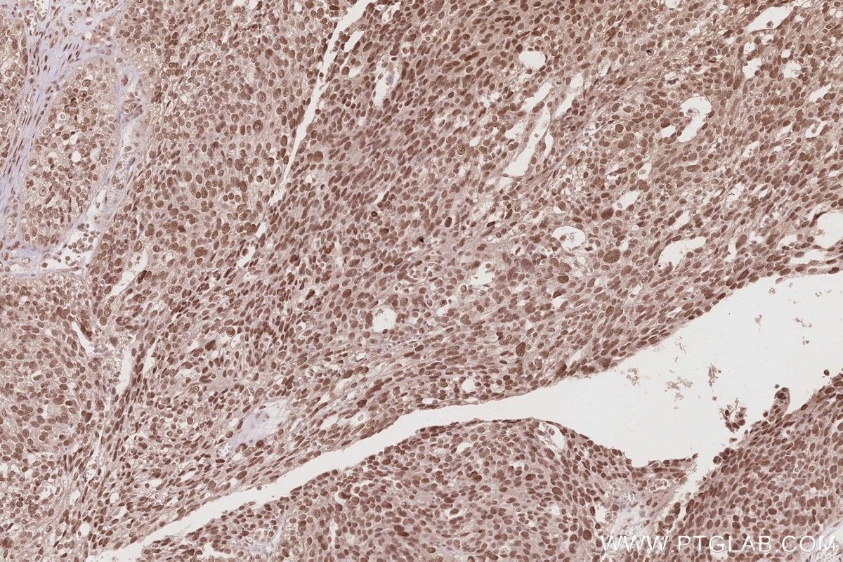 Immunohistochemistry (IHC) staining of human ovary cancer tissue using WRAP53 Polyclonal antibody (14761-1-AP)