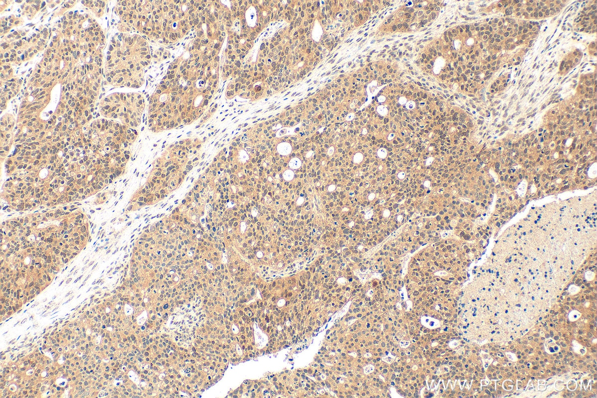 Immunohistochemistry (IHC) staining of human ovary tumor tissue using WRAP53 Polyclonal antibody (14761-1-AP)