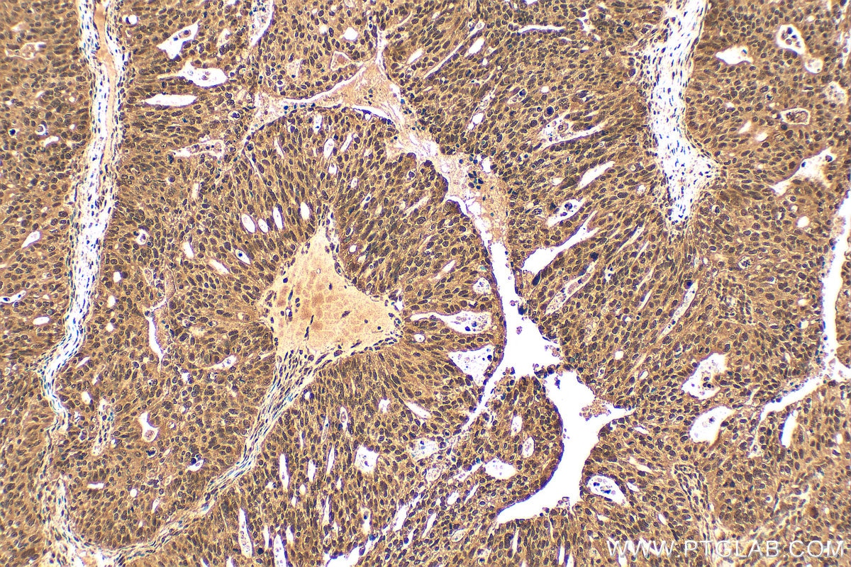IHC staining of human ovary tumor using RMX00057 Immunohistochemistry (IHC) staining of human ovary tumor tissue using Multi-rAb® WRAP53 Multi-Recombinant antibody (RMX00057)