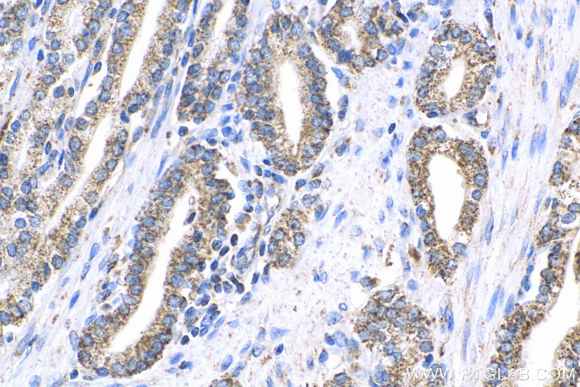 Immunohistochemistry (IHC) staining of human prostate cancer tissue using WSB1 Polyclonal antibody (11666-1-AP)