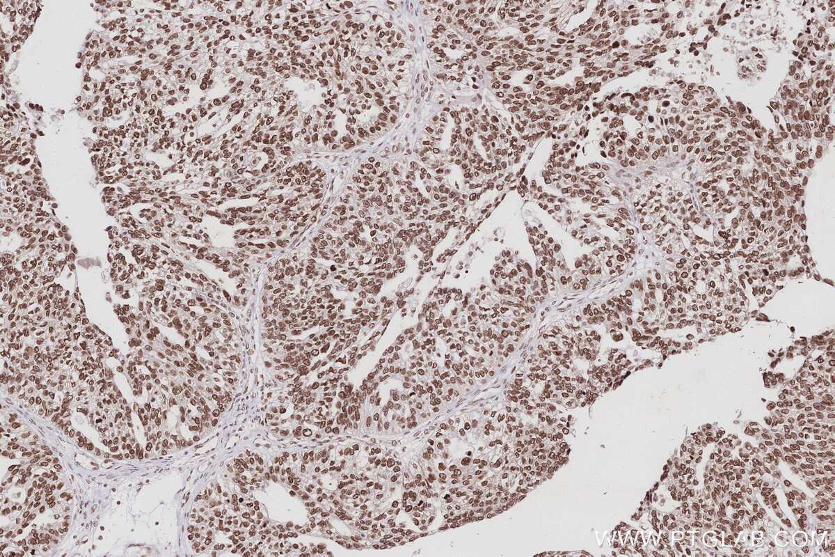 IHC staining of human ovary cancer using 26641-1-AP Immunohistochemistry (IHC) staining of human ovary cancer tissue using WSTF Polyclonal antibody (26641-1-AP)