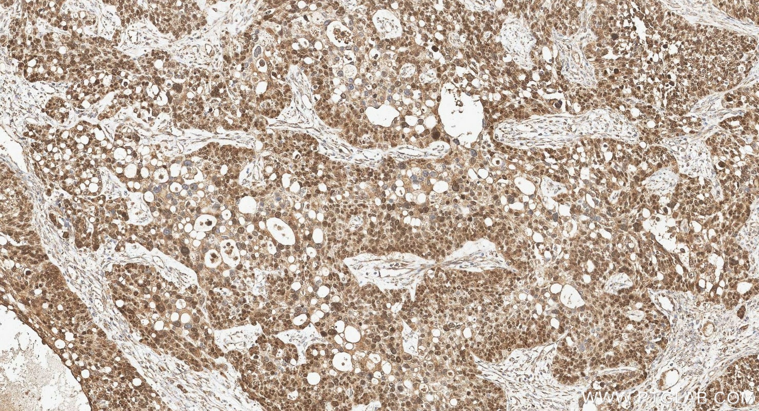 IHC staining of human ovary cancer using 12609-1-AP Immunohistochemistry (IHC) staining of human ovary cancer tissue using WT1 Polyclonal antibody (12609-1-AP)