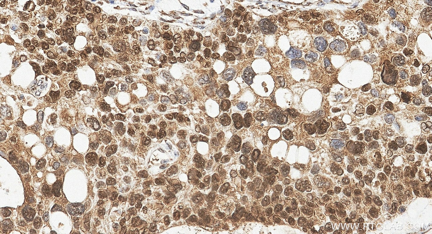 IHC staining of human ovary cancer using 12609-1-AP Immunohistochemistry (IHC) staining of human ovary cancer tissue using WT1 Polyclonal antibody (12609-1-AP)