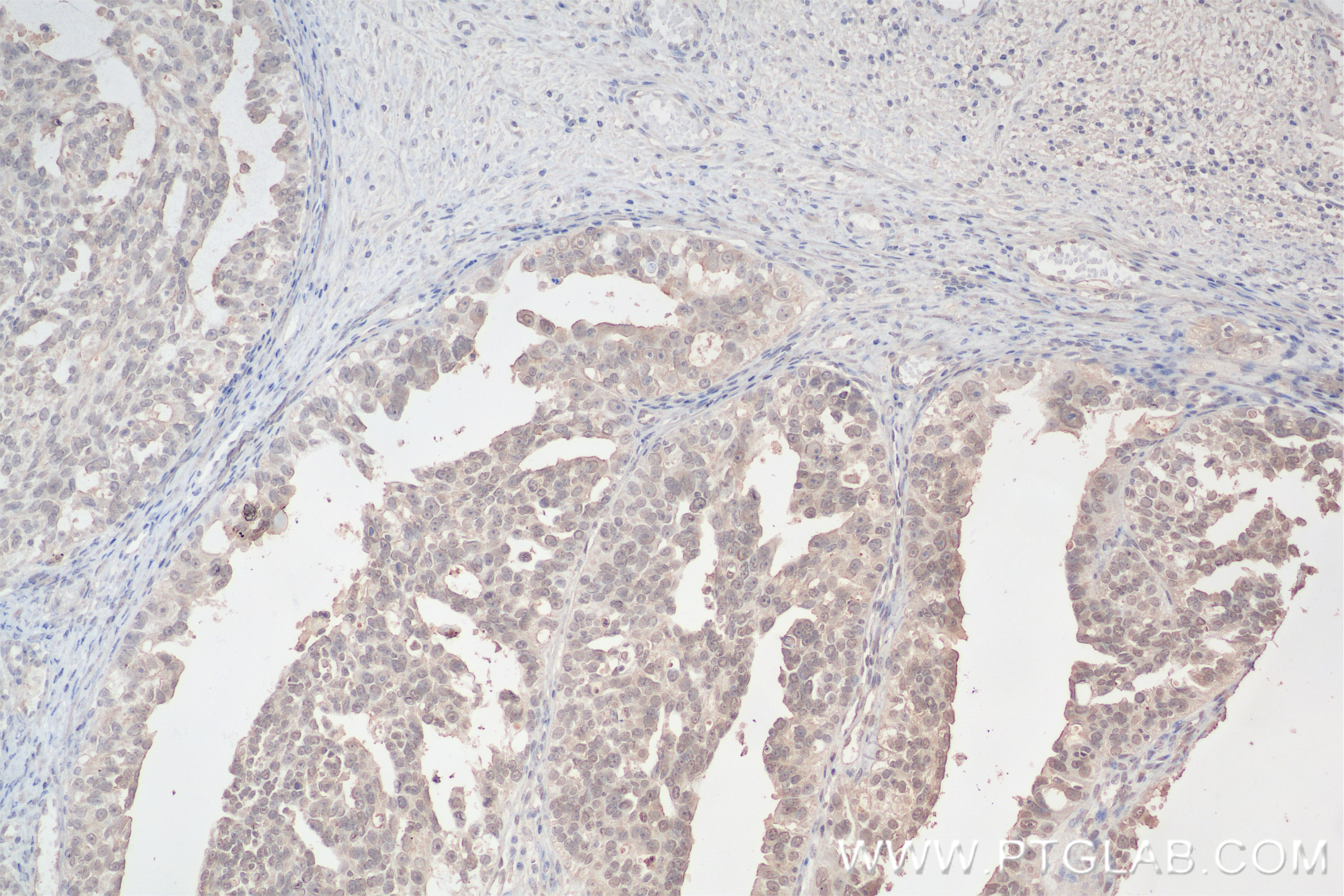 Immunohistochemistry (IHC) staining of human ovary cancer tissue using WT1 Recombinant antibody (82525-1-RR)