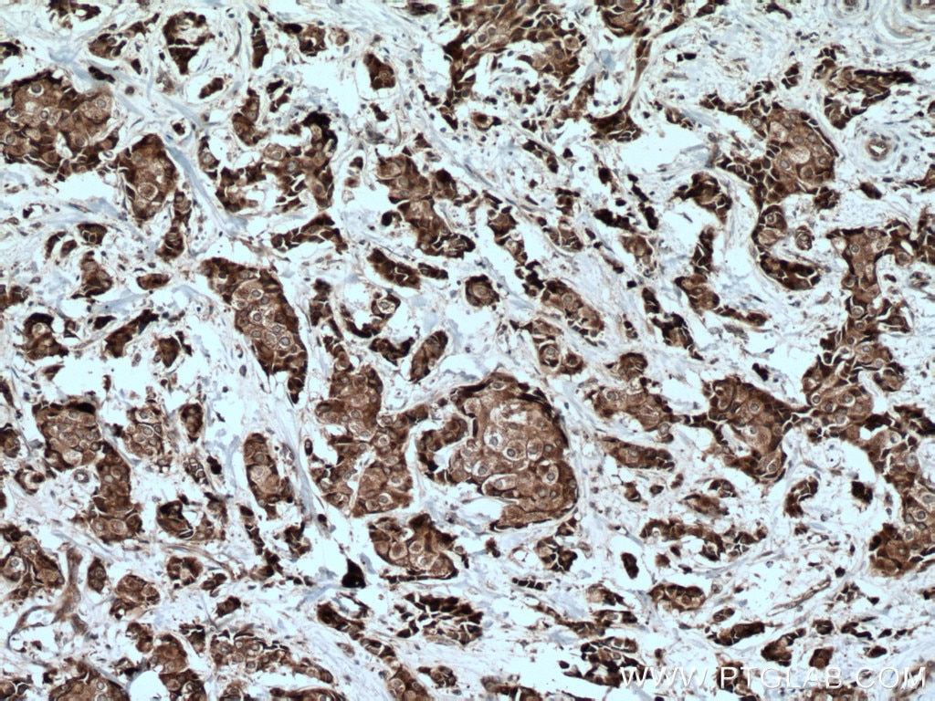 Immunohistochemistry (IHC) staining of human breast cancer tissue using WWOX Polyclonal antibody (15299-1-AP)