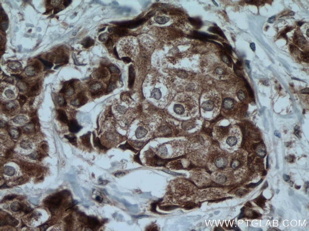 Immunohistochemistry (IHC) staining of human breast cancer tissue using WWOX Polyclonal antibody (15299-1-AP)
