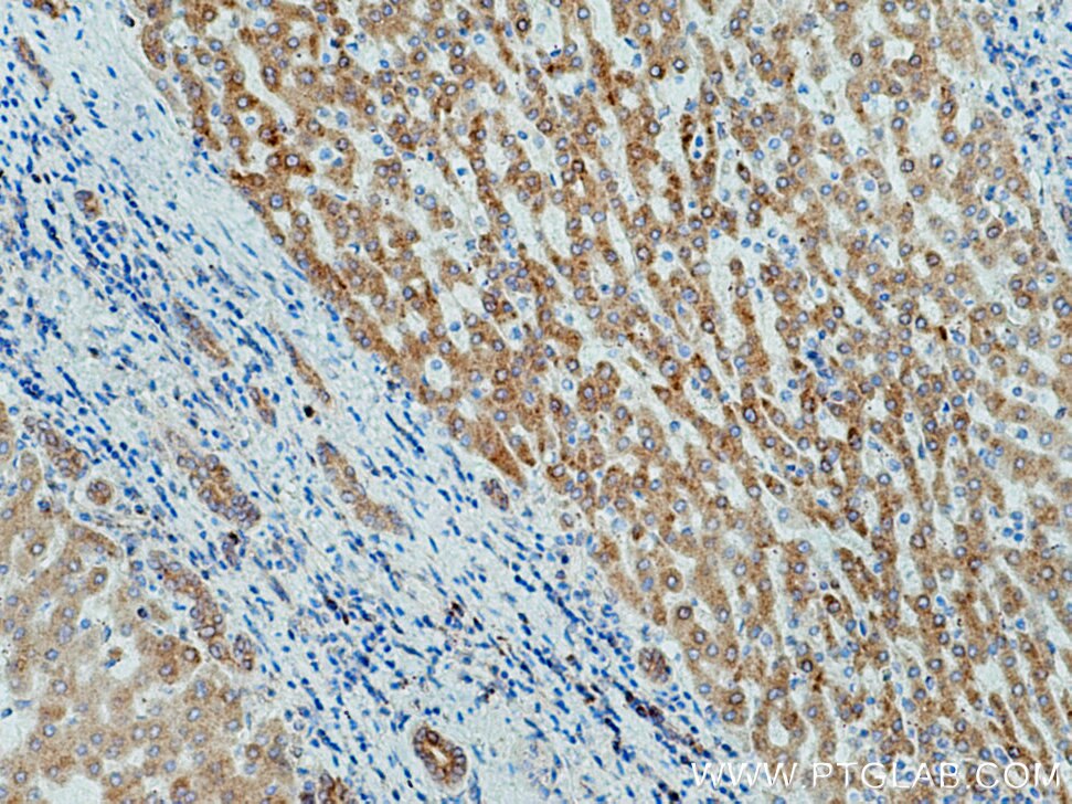 Immunohistochemistry (IHC) staining of human liver cancer tissue using WWOX Polyclonal antibody (15299-1-AP)