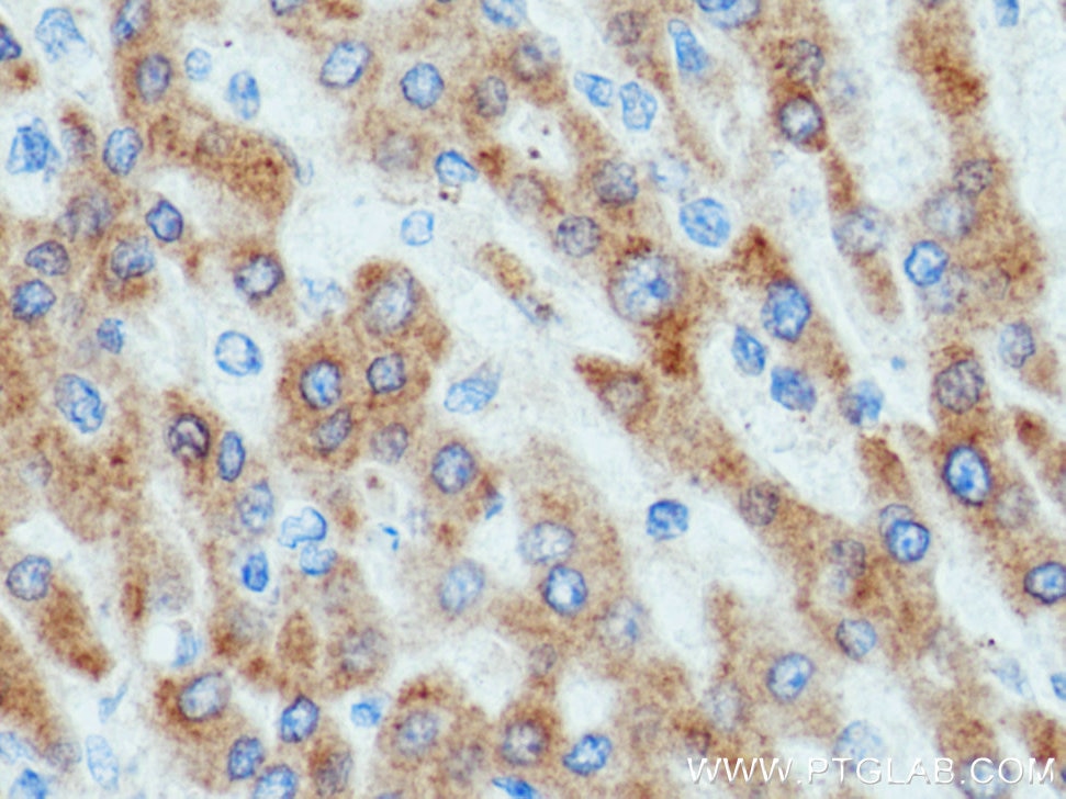 Immunohistochemistry (IHC) staining of human liver cancer tissue using WWOX Polyclonal antibody (15299-1-AP)