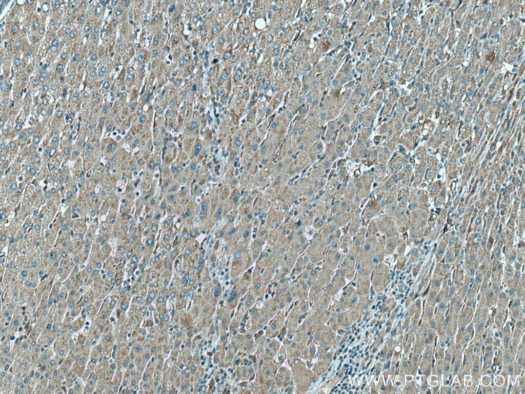Immunohistochemistry (IHC) staining of human liver cancer tissue using WWP1 Polyclonal antibody (28689-1-AP)