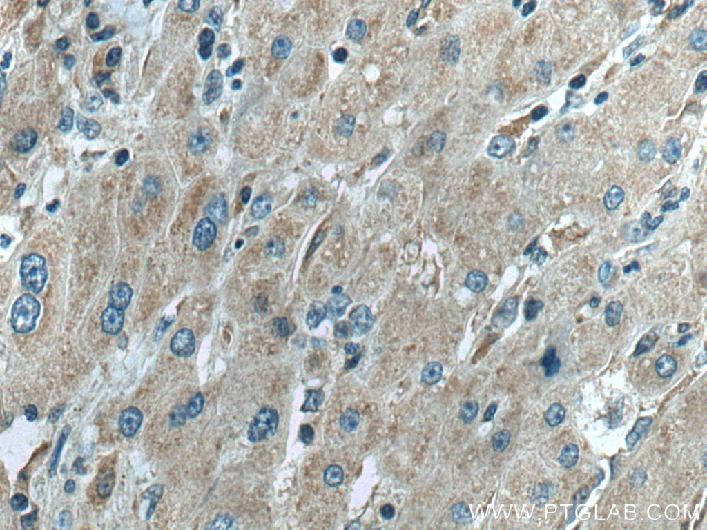 Immunohistochemistry (IHC) staining of human liver cancer tissue using WWP1 Polyclonal antibody (28689-1-AP)
