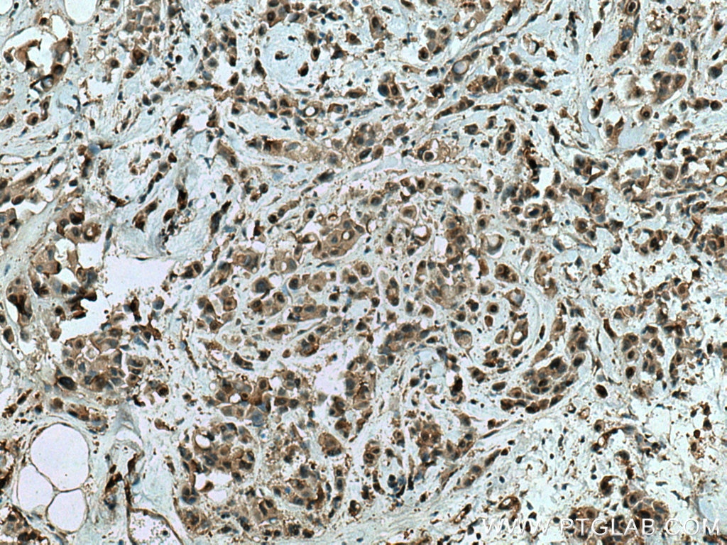 Immunohistochemistry (IHC) staining of human breast cancer tissue using WWP1 Polyclonal antibody (28689-1-AP)