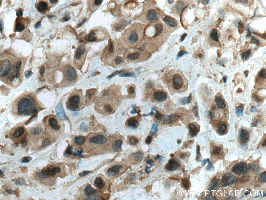 Immunohistochemistry (IHC) staining of human breast cancer tissue using WWP1 Polyclonal antibody (28689-1-AP)