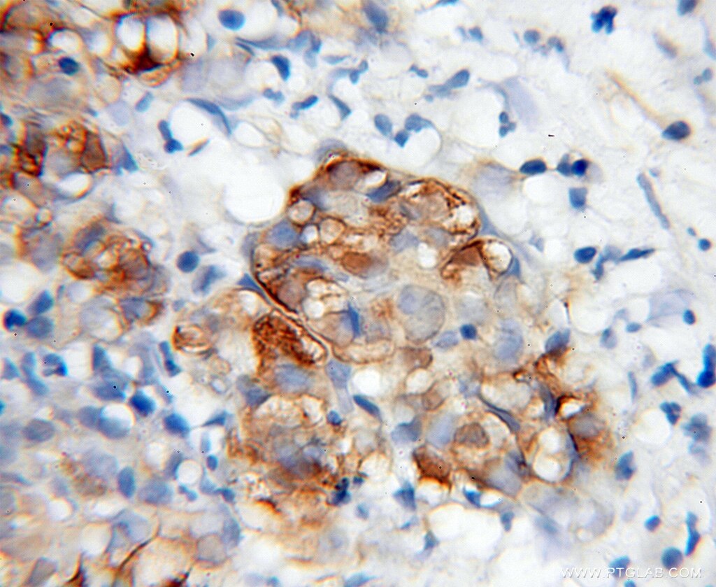 Immunohistochemistry (IHC) staining of human pancreas cancer tissue using WWP2 Polyclonal antibody (12197-1-AP)