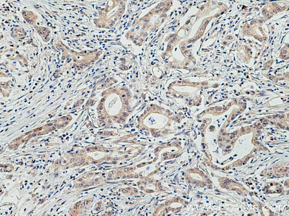 Immunohistochemistry (IHC) staining of human pancreas cancer tissue using WWP2 Monoclonal antibody (67274-1-Ig)