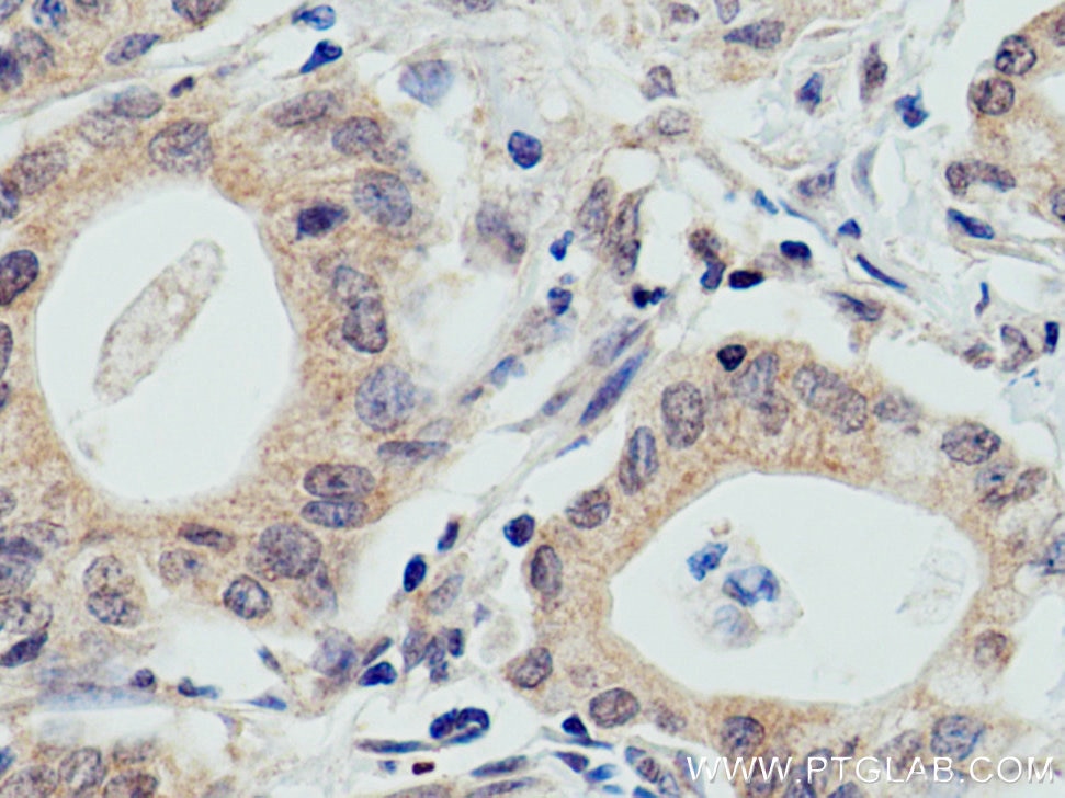 Immunohistochemistry (IHC) staining of human pancreas cancer tissue using WWP2 Monoclonal antibody (67274-1-Ig)