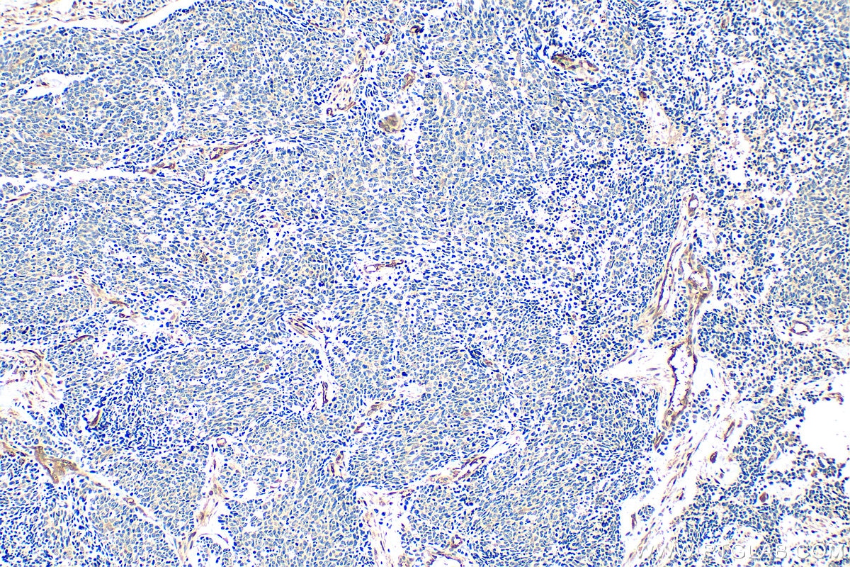 Immunohistochemical analysis of paraffin-embedded human lung cancer tissue slide using 23306-1-AP (WWTR1/TAZ antibody) at dilution of 1:200 (under 10x lens). Heat mediated antigen retrieval with Tris-EDTA buffer (pH 9.0). Immunohistochemistry (IHC) staining of human lung cancer tissue using WWTR1/TAZ Polyclonal antibody (23306-1-AP)