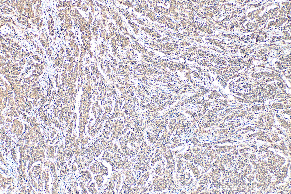 Immunohistochemical analysis of paraffin-embedded human colon cancer tissue slide using 23306-1-AP (WWTR1/TAZ antibody) at dilution of 1:200 (under 10x lens). Heat mediated antigen retrieval with Tris-EDTA buffer (pH 9.0). Immunohistochemistry (IHC) staining of human colon cancer tissue using WWTR1/TAZ Polyclonal antibody (23306-1-AP)