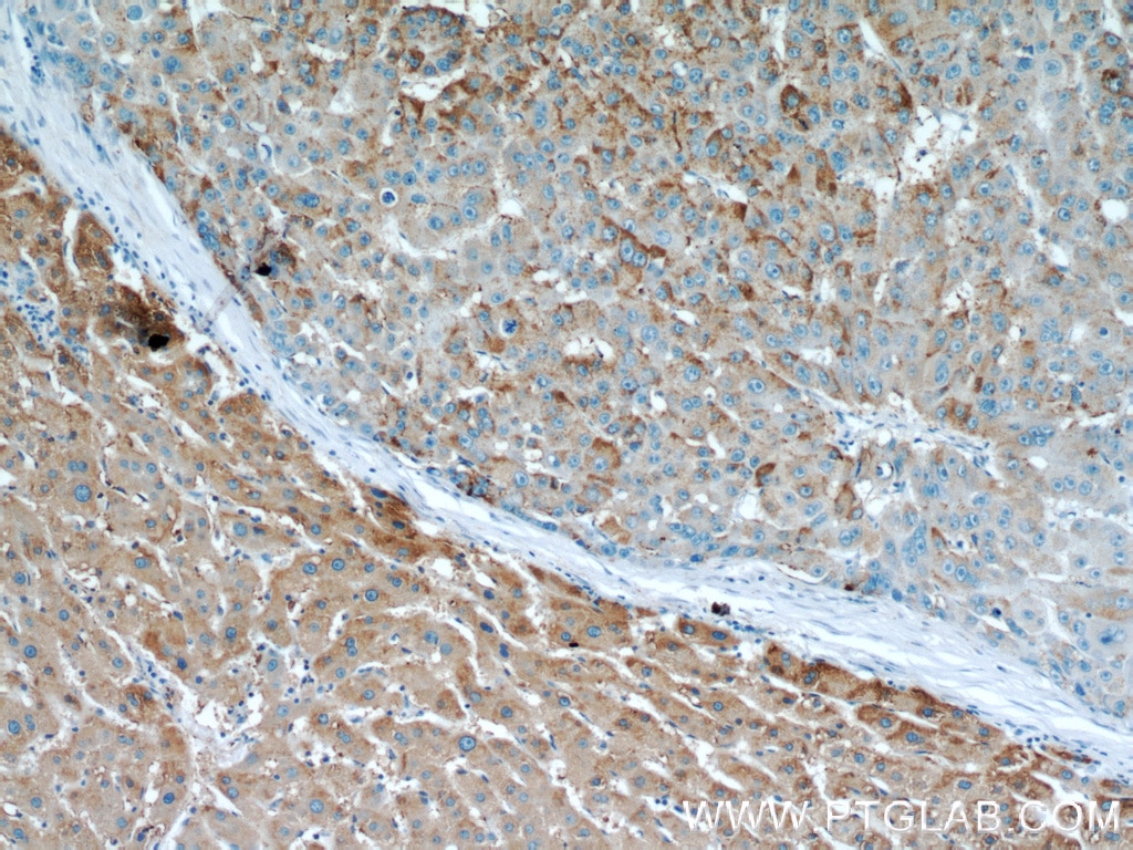 Immunohistochemistry (IHC) staining of human liver cancer tissue using Willin Polyclonal antibody (21039-1-AP)