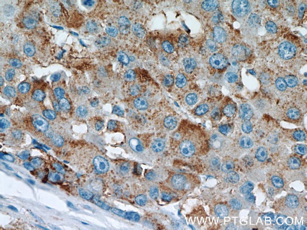 Immunohistochemistry (IHC) staining of human liver cancer tissue using Willin Polyclonal antibody (21039-1-AP)