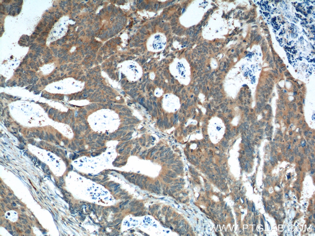 Immunohistochemistry (IHC) staining of human colon cancer tissue using XBP1S/XBP1U Polyclonal antibody (24168-1-AP)