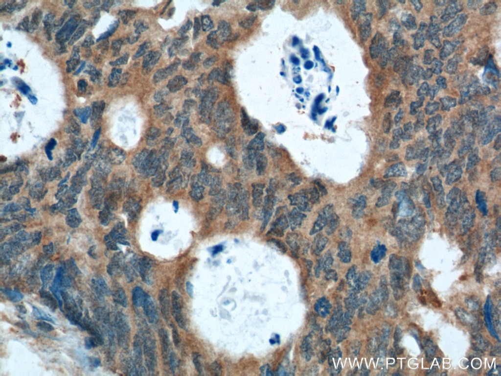Immunohistochemistry (IHC) staining of human colon cancer tissue using XBP1S/XBP1U Polyclonal antibody (24168-1-AP)