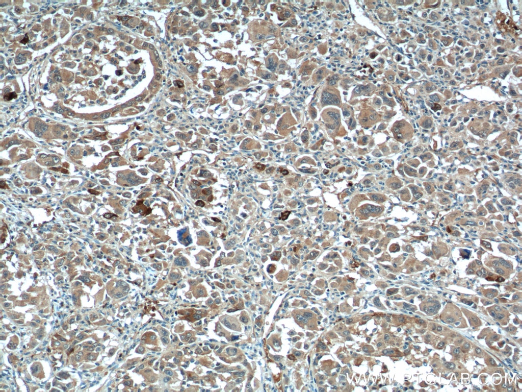 Immunohistochemistry (IHC) staining of human liver cancer tissue using XBP1S/XBP1U Polyclonal antibody (24168-1-AP)