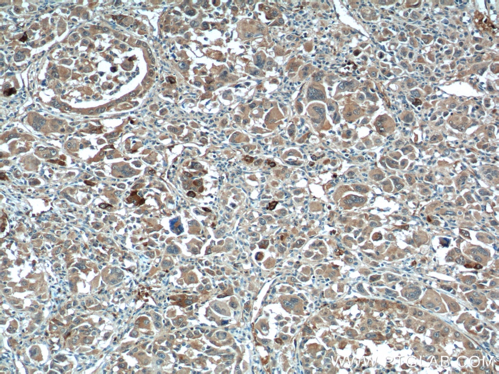 IHC staining of human liver cancer using 24168-1-AP