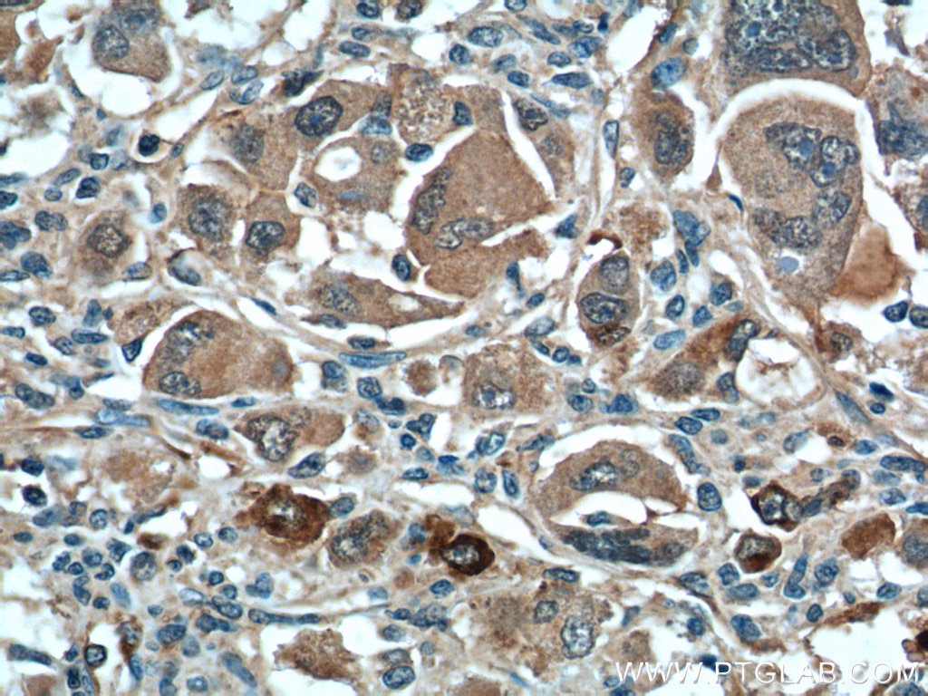 Immunohistochemistry (IHC) staining of human liver cancer tissue using XBP1S/XBP1U Polyclonal antibody (24168-1-AP)