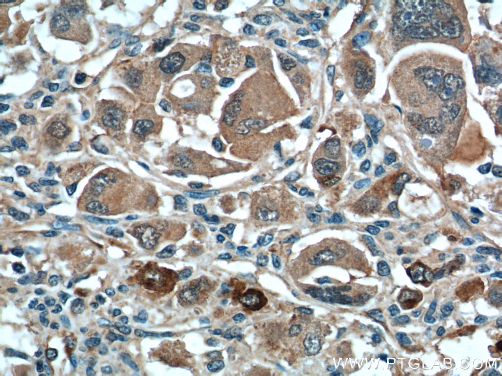 IHC staining of human liver cancer using 24168-1-AP