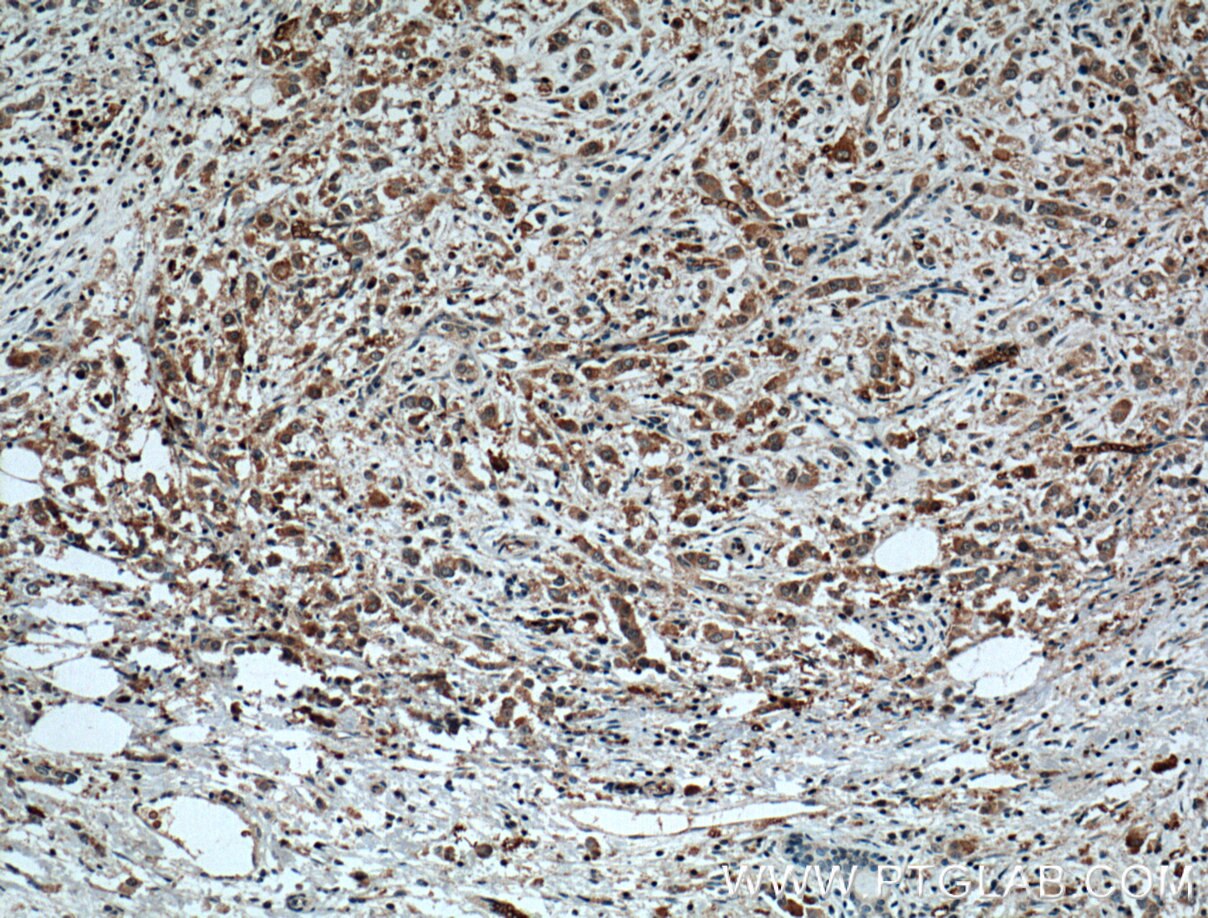 Immunohistochemistry (IHC) staining of human breast cancer tissue using XBP1S/XBP1U Polyclonal antibody (24168-1-AP)