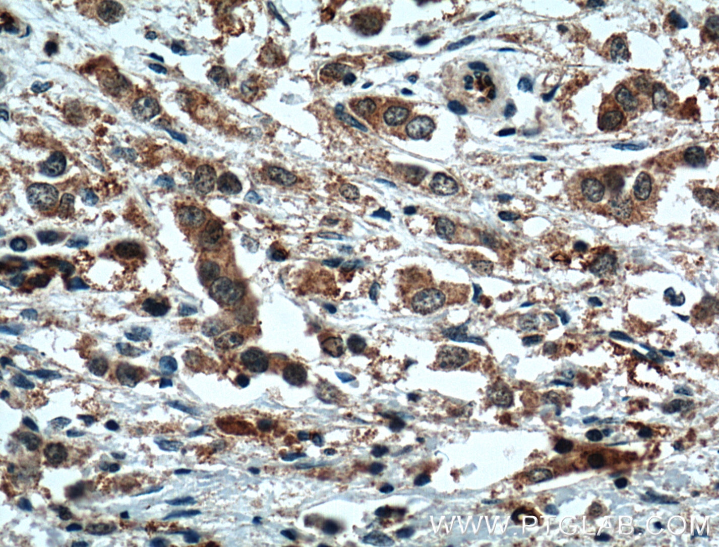 Immunohistochemistry (IHC) staining of human breast cancer tissue using XBP1S/XBP1U Polyclonal antibody (24168-1-AP)