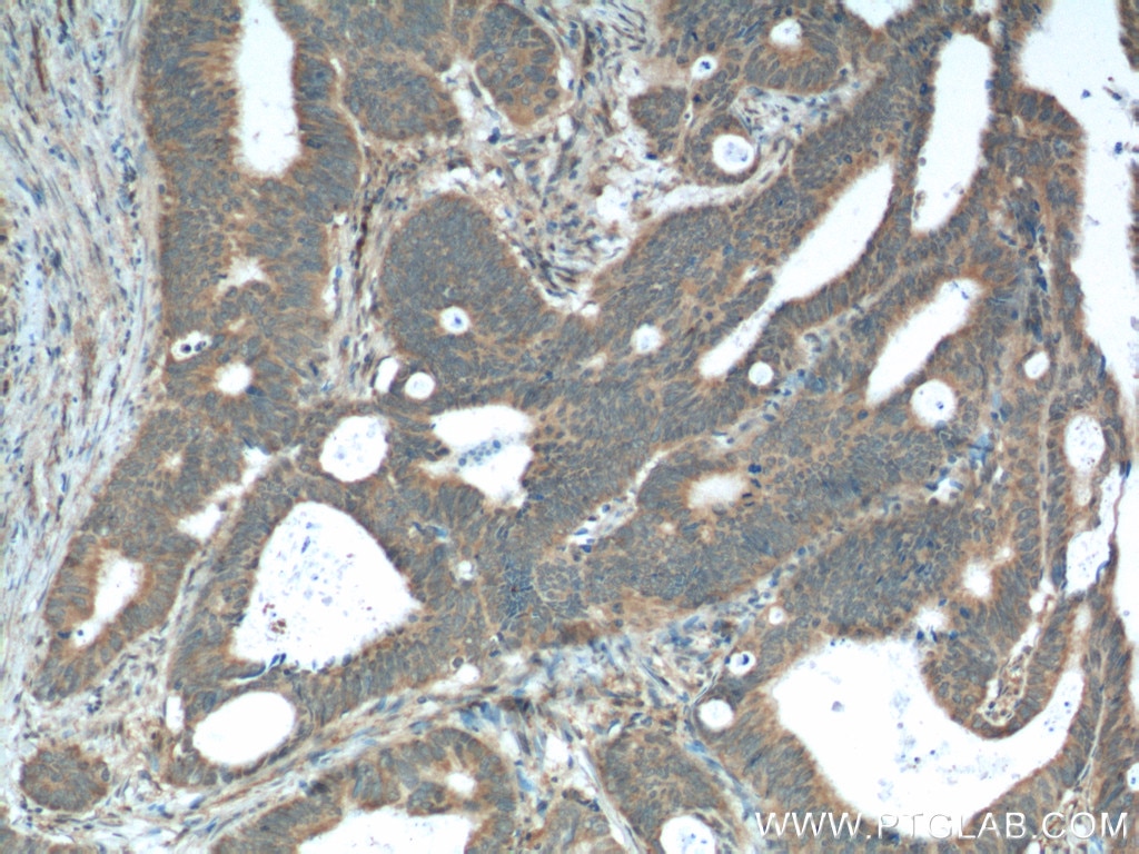 Immunohistochemistry (IHC) staining of human colon cancer tissue using XBP-1U specific Polyclonal antibody (25997-1-AP)