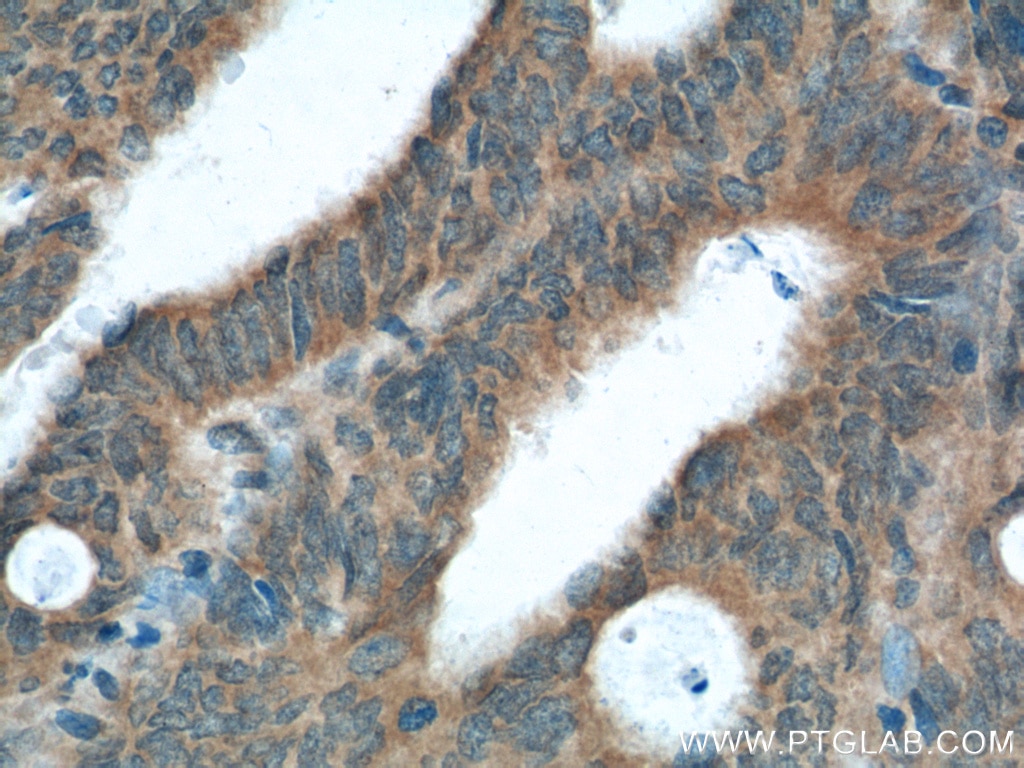 Immunohistochemistry (IHC) staining of human colon cancer tissue using XBP-1U specific Polyclonal antibody (25997-1-AP)