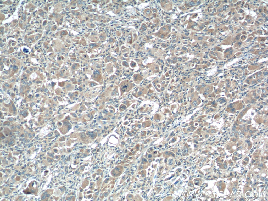 Immunohistochemistry (IHC) staining of human liver cancer tissue using XBP-1U specific Polyclonal antibody (25997-1-AP)