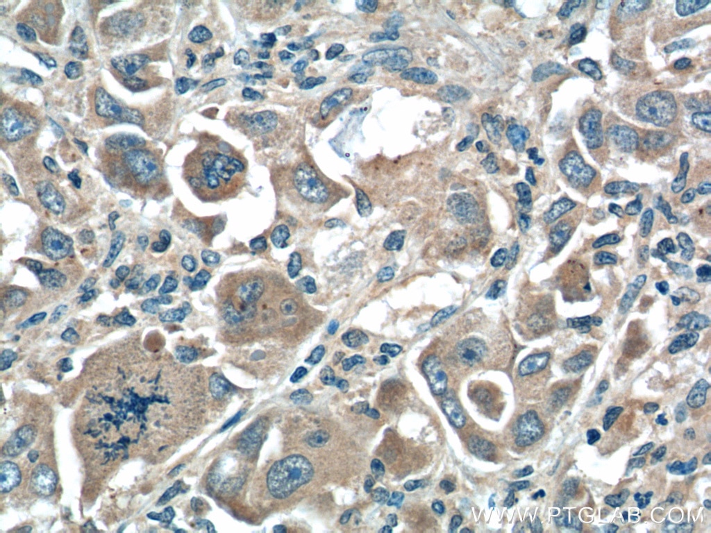 Immunohistochemistry (IHC) staining of human liver cancer tissue using XBP-1U specific Polyclonal antibody (25997-1-AP)