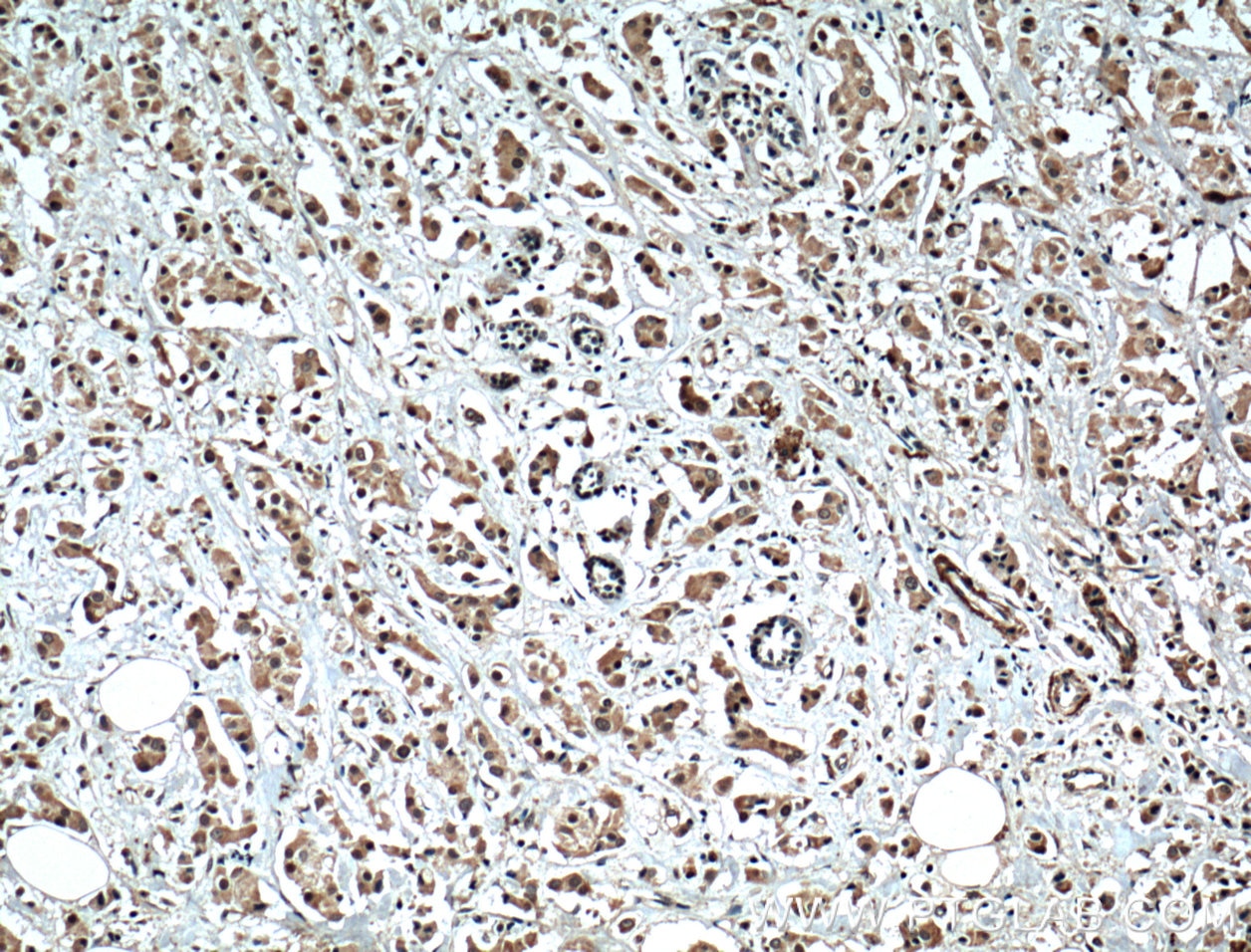 Immunohistochemistry (IHC) staining of human breast cancer tissue using XBP-1U specific Polyclonal antibody (25997-1-AP)