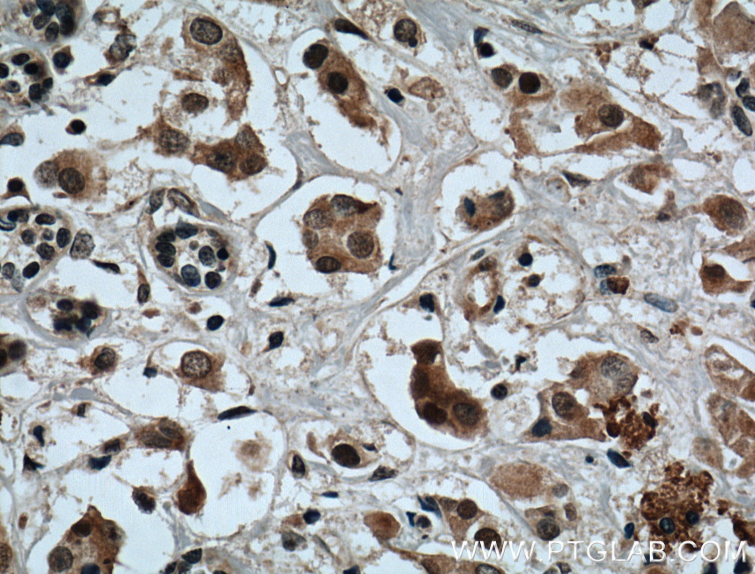 Immunohistochemistry (IHC) staining of human breast cancer tissue using XBP-1U specific Polyclonal antibody (25997-1-AP)