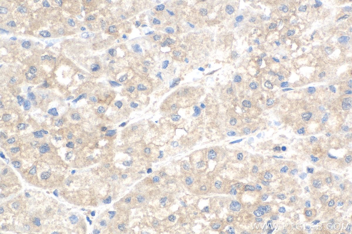 Immunohistochemistry (IHC) staining of human liver cancer tissue using XBP1S-specific Polyclonal antibody (24868-1-AP)