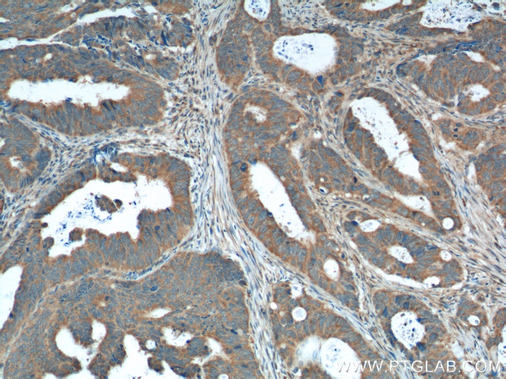 Immunohistochemistry (IHC) staining of human colon cancer tissue using XBP1S-specific Polyclonal antibody (24868-1-AP)