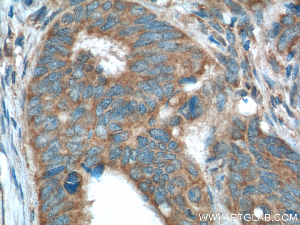 Immunohistochemistry (IHC) staining of human colon cancer tissue using XBP1S-specific Polyclonal antibody (24868-1-AP)